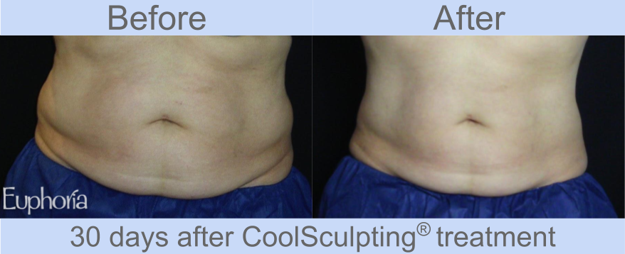 CoolSculpting Beauty Choice Awards 2013 & 2014