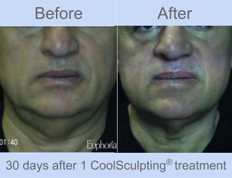 CoolSculpting Beauty Choice Awards 2013 & 2014