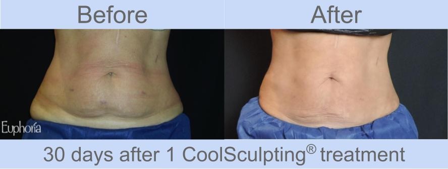 CoolSculpting Beauty Choice Awards 2013 & 2014